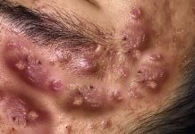 Cystic Blackheads Extraction