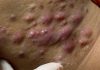 Cystic Acne Blackheads Extraction