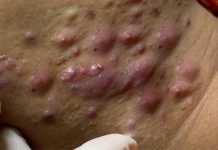 Cystic Acne Blackheads Extraction