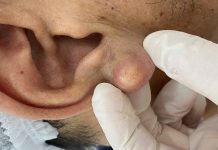 Big Cystic Blackheads