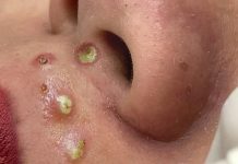 Big Cystic Blackheads Whiteheads