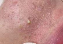 Acne Extraction Pimple