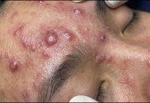 Acne Blackheads Extraction