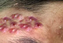 Cystic Blackheads Extraction