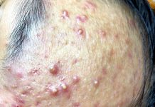 Acne Blackheads Extraction Whiteheads