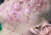 Cystic Acne Blackheads Extraction