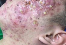 Cystic Acne Blackheads Extraction