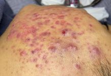 Cystic Acne Blackheads Extraction