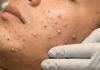 Cystic Acne Blackheads Whiteheads
