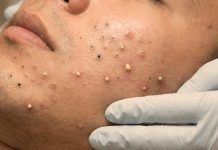 Cystic Acne Blackheads Whiteheads
