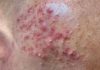 Cystic Acne Extraction Pimples