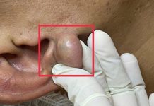 Big Cystic Blackheads Extraction