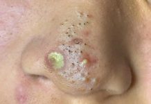 Cystic Blackheads Whiteheads