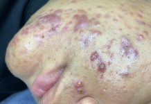 Cystic Acne Blackheads Extraction