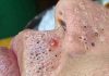 Cystic Blackheads Extraction