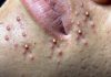 Cystic Acne Blackheads Extraction Whiteheads