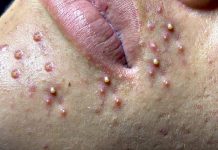 Cystic Acne Blackheads Extraction Whiteheads