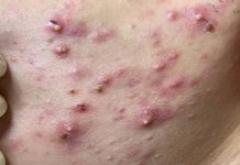 Acne Blackheads Extraction