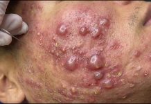 Big Cystic Acne Blackheads Extraction