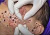 Big Cystic Acne Blackheads Extraction