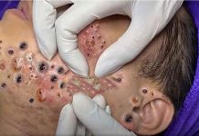 Big Cystic Acne Blackheads Extraction