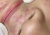 Cystic Blackheads Extraction