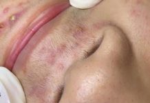 Cystic Blackheads Extraction