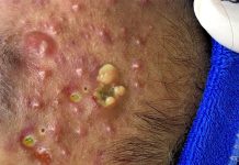 Blackheads Extraction Whiteheads