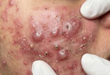 Cystic Blackheads Extraction