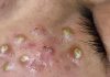 Cystic Acne Extraction Whiteheads