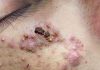 Cystic Acne Blackheads Extraction