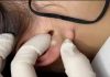 Cystic Blackheads Extraction