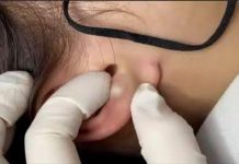 Cystic Blackheads Extraction