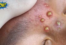 Acne Extraction Whiteheads