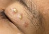 Acne Blackheads Extraction Whiteheads