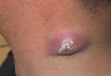Big Cystic Blackheads Extraction