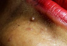 Acne Extraction Pimples
