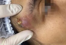 Cystic Blackheads and Whiteheads
