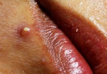 Cystic Acne Whiteheads