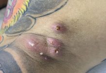 Blackheads Extraction Whiteheads