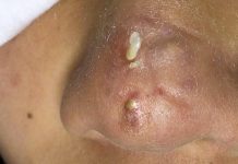 Cystic Blackheads Whiteheads