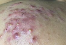 Cystic Acne Blackheads Extraction