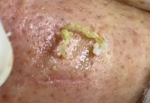 Blackheads Extraction Whiteheads