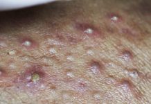 Acne Extraction Pimples