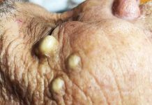 Big Cystic Acne Blackheads Extraction