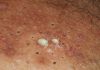 Blackheads Extraction Whiteheads