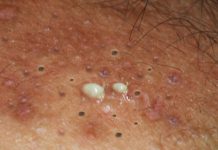 Blackheads Extraction Whiteheads