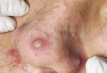 Cystic Blackheads Extraction Whiteheads