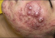 Cystic Acne Blackheads Extraction