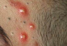 Cystic Blackheads Whiteheads
